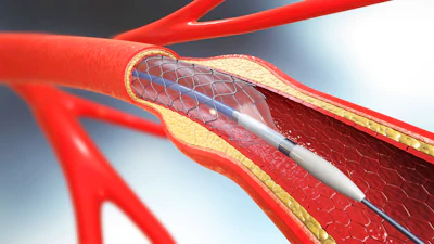 Tekni Plex Catheter Stent
